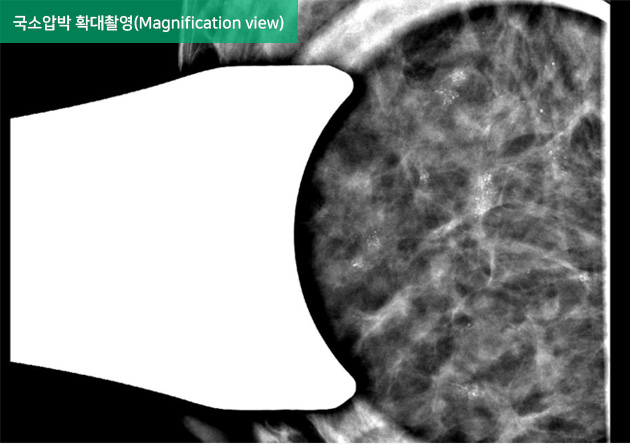 국소압박 확대촬영(Magnification view)