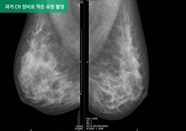 과거 CR 장비로 찍은 유방 촬영