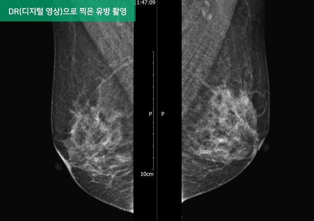 DR(디지털 영상)으로 찍은 유방 촬영