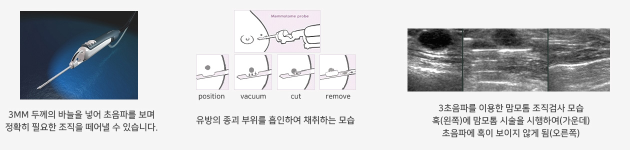 미세석회 맘모톰 생검으로 유방암을 조기 진단한 사례 사진