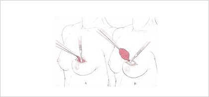 절제 생검(절제 수술을 통한 조직검사)