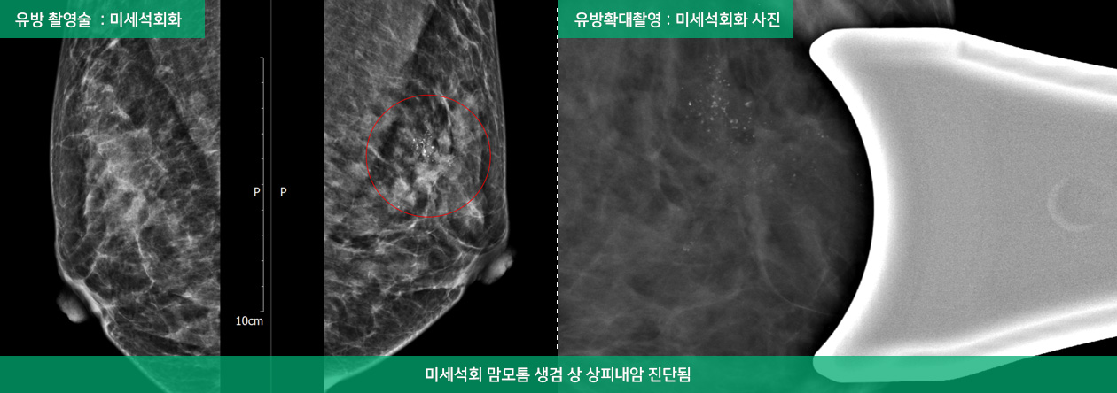 유방 촬영술과 유방확대촬영