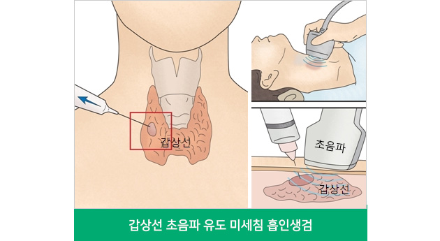 갑상선 초음파 유도 미세침 흡인생검