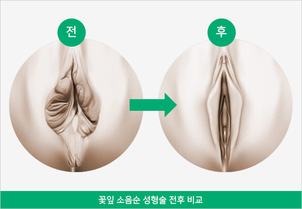 꽃잎 소음순 성형술 전후 비교