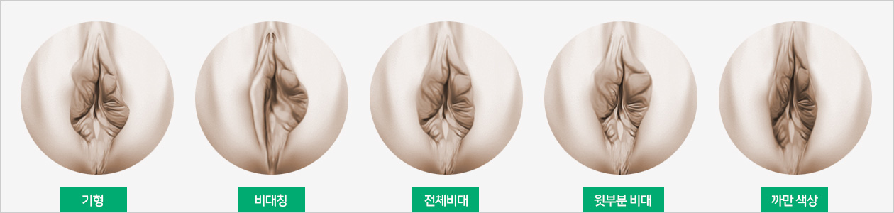 소음순 수술사진