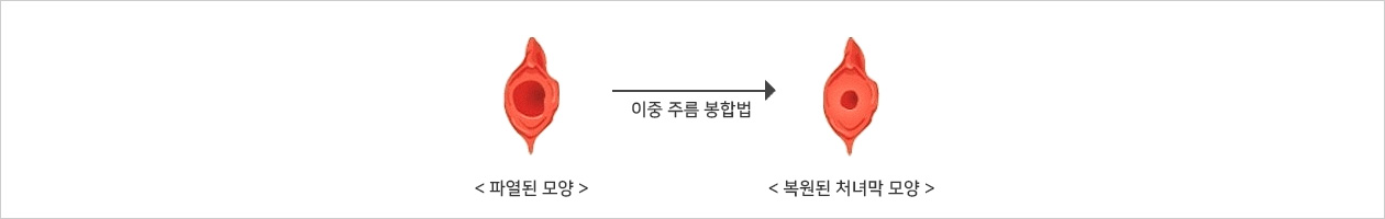 처녀막 복원