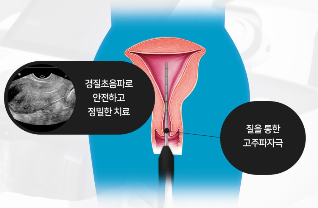 갑상선