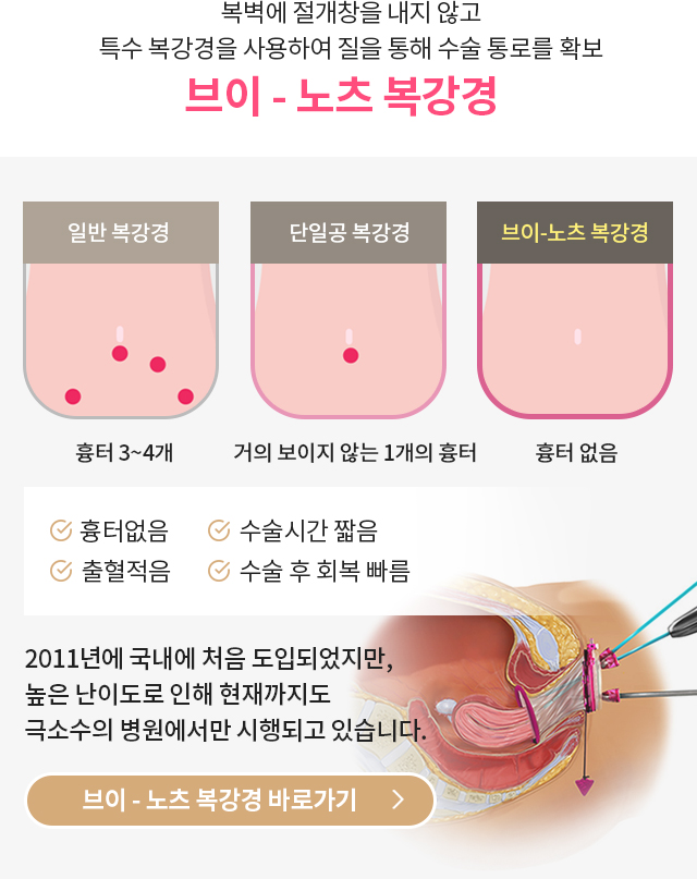 브이-노츠 복강경 바로가기